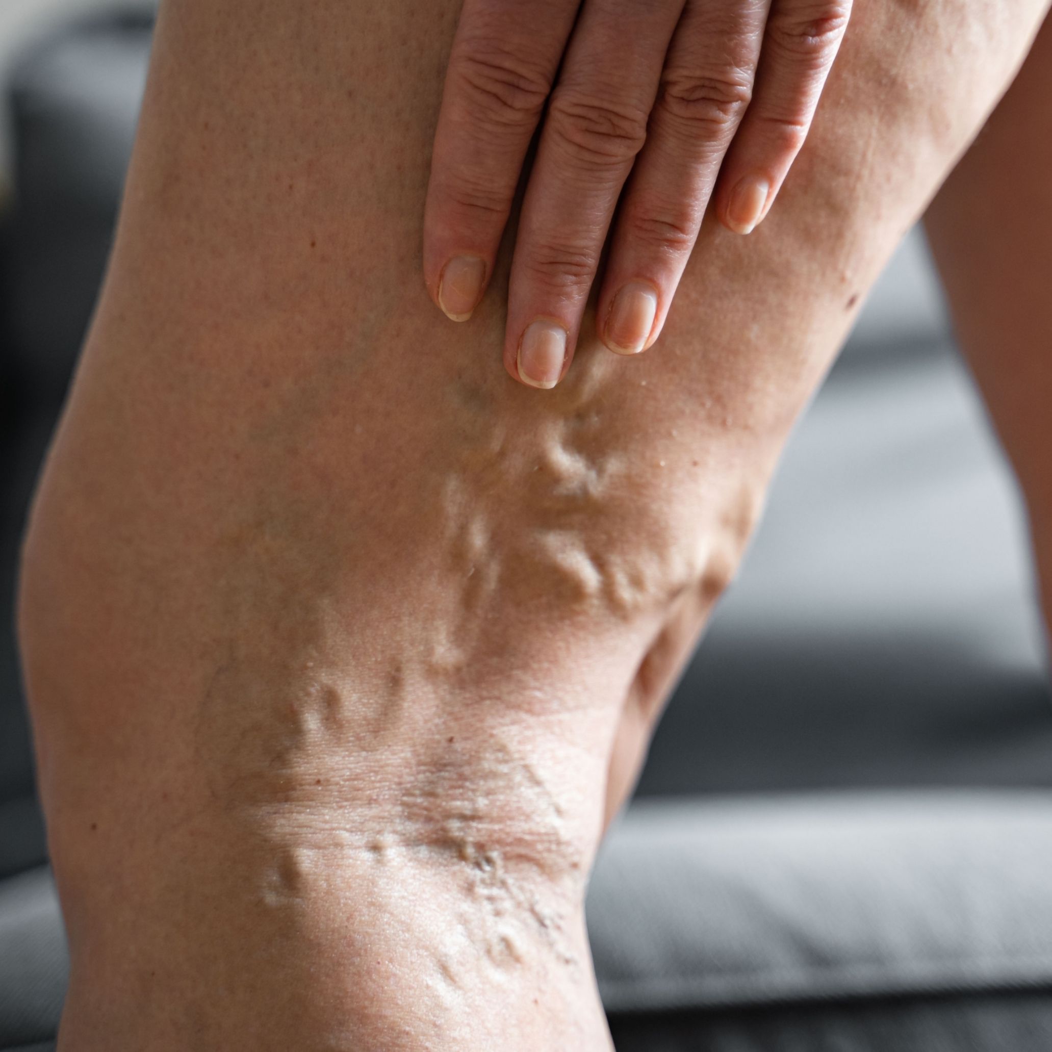 The Hidden Dangers of Delaying Varicose Vein Treatment Image