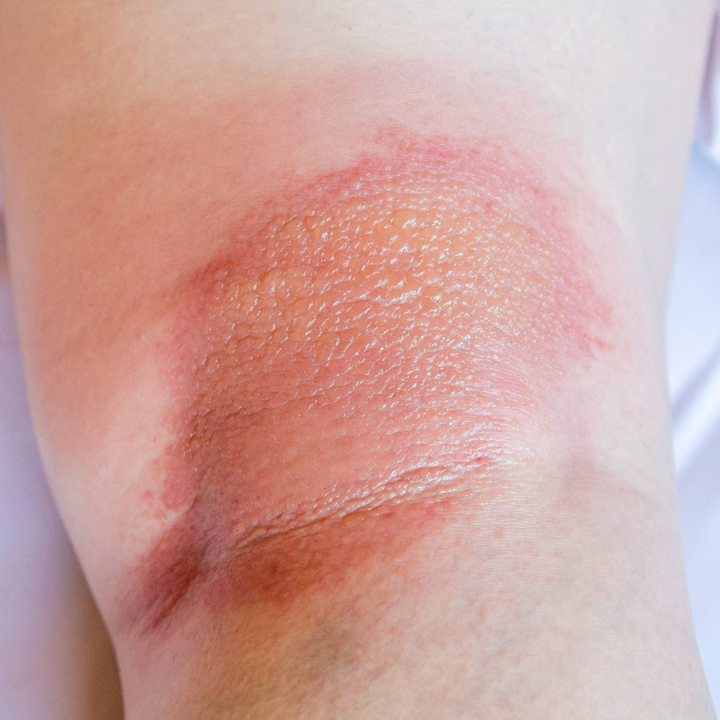 Could Your Itchy Eczema be a Sign of Venous Problems? Image