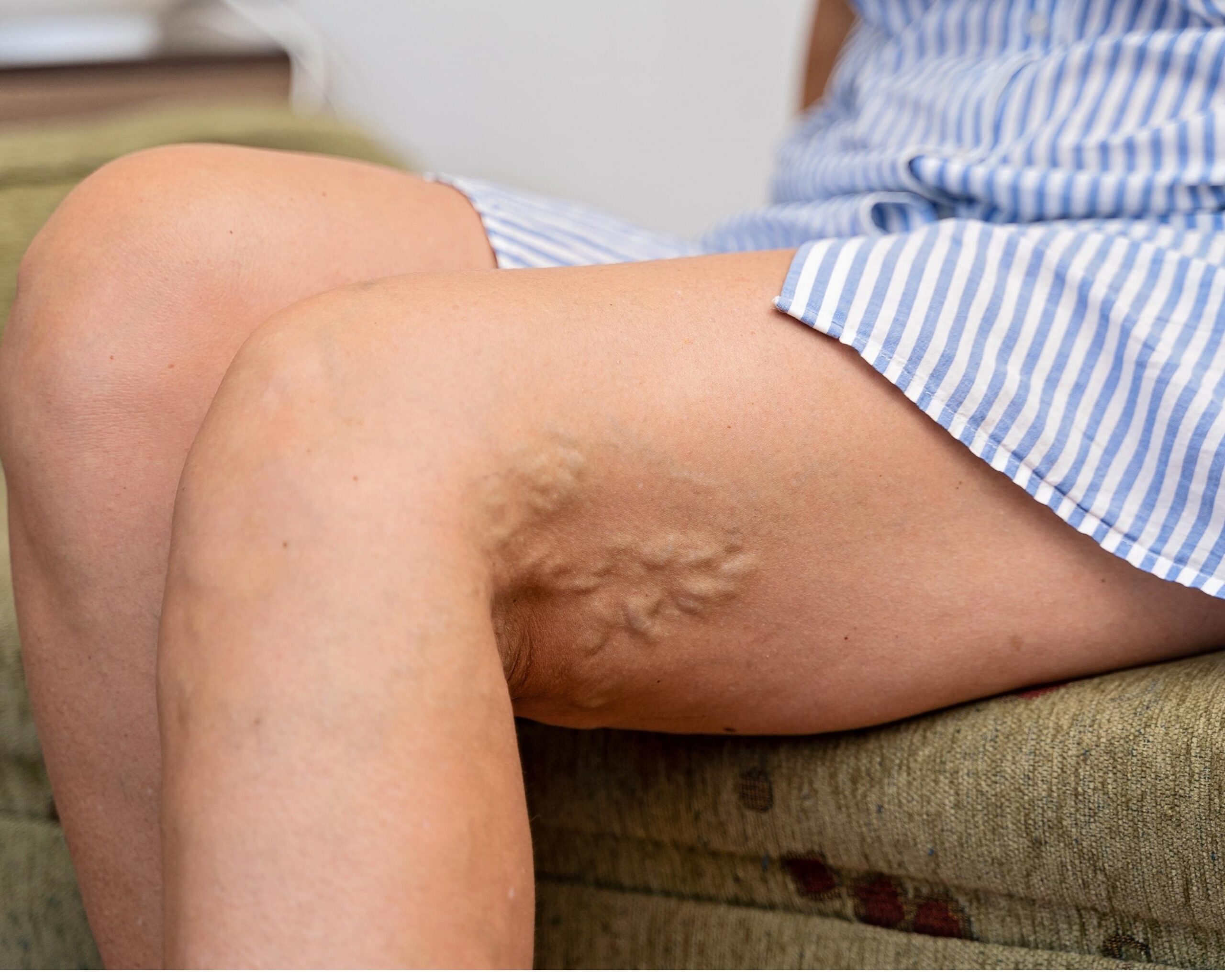 Why Some Varicose Vein Treatments Look Good at First… But Disappoint Later (The Problem with MOCA) Image