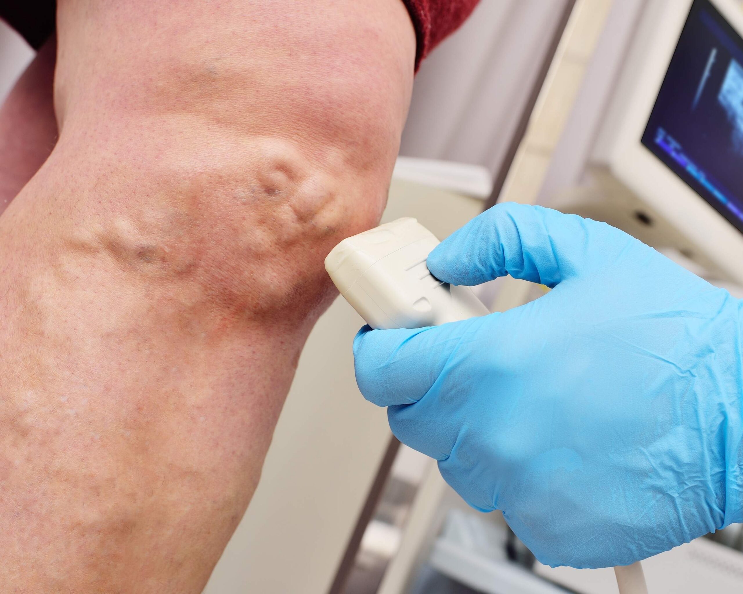 Can Ultrasound Uncover Hidden Skin Problems Linked to Vein Disease? Image