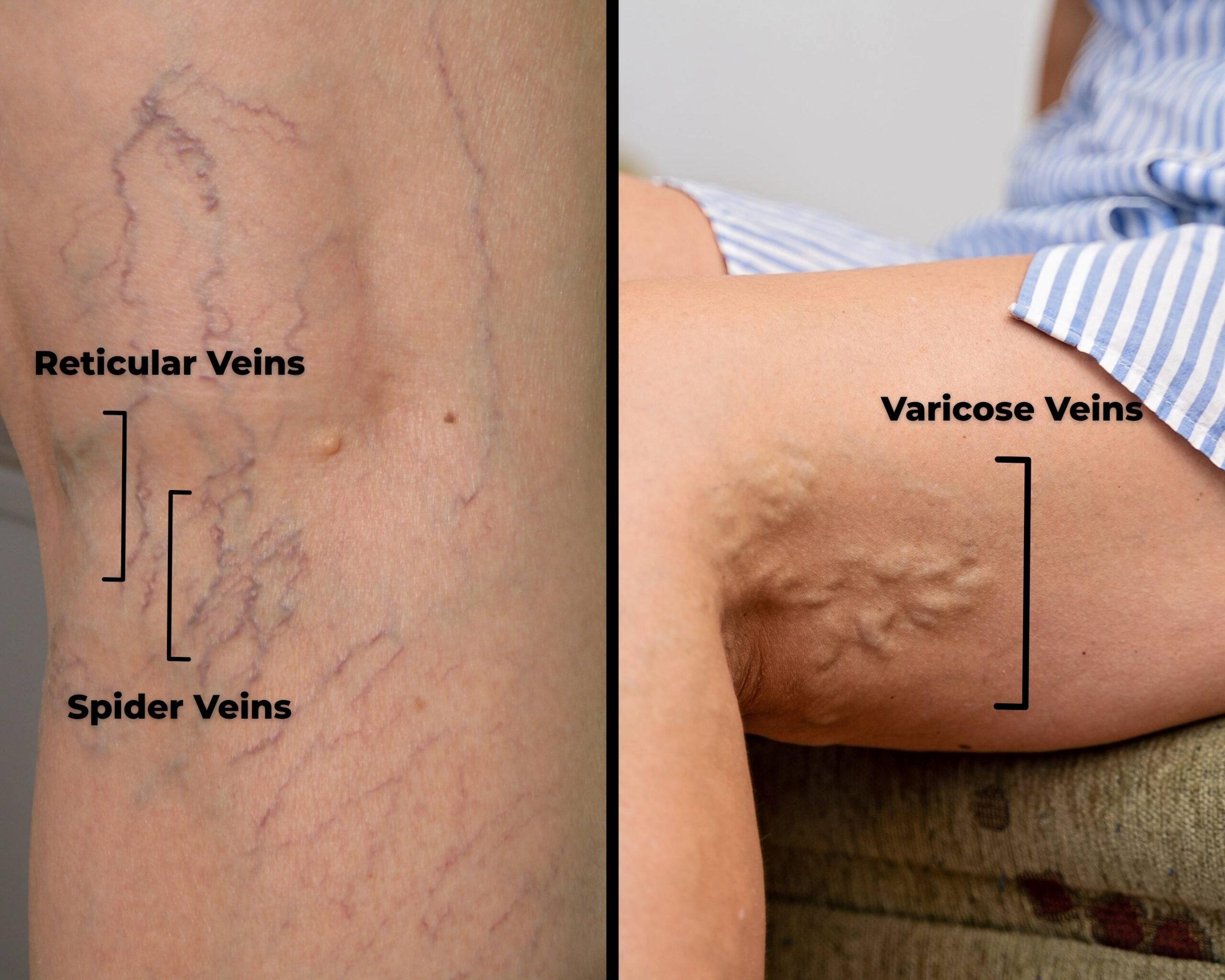 Spider Veins vs. Varicose Veins: Which Do You Have and What Can You Do? Image