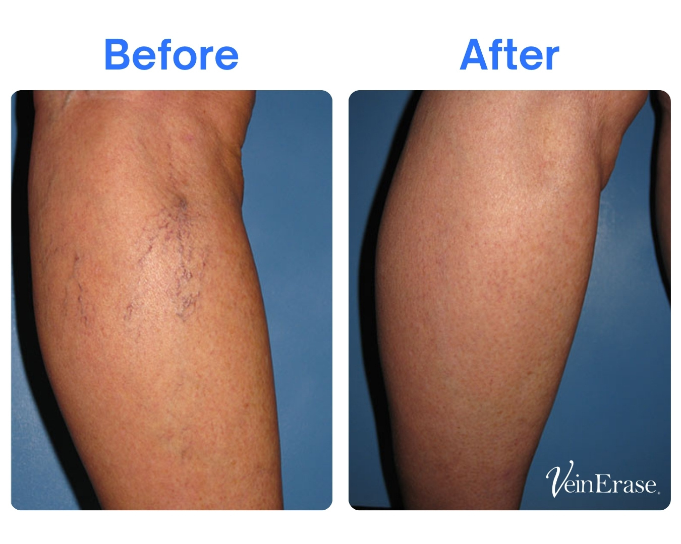 Everything You Need to Know About Spider Veins and Their Treatment Image