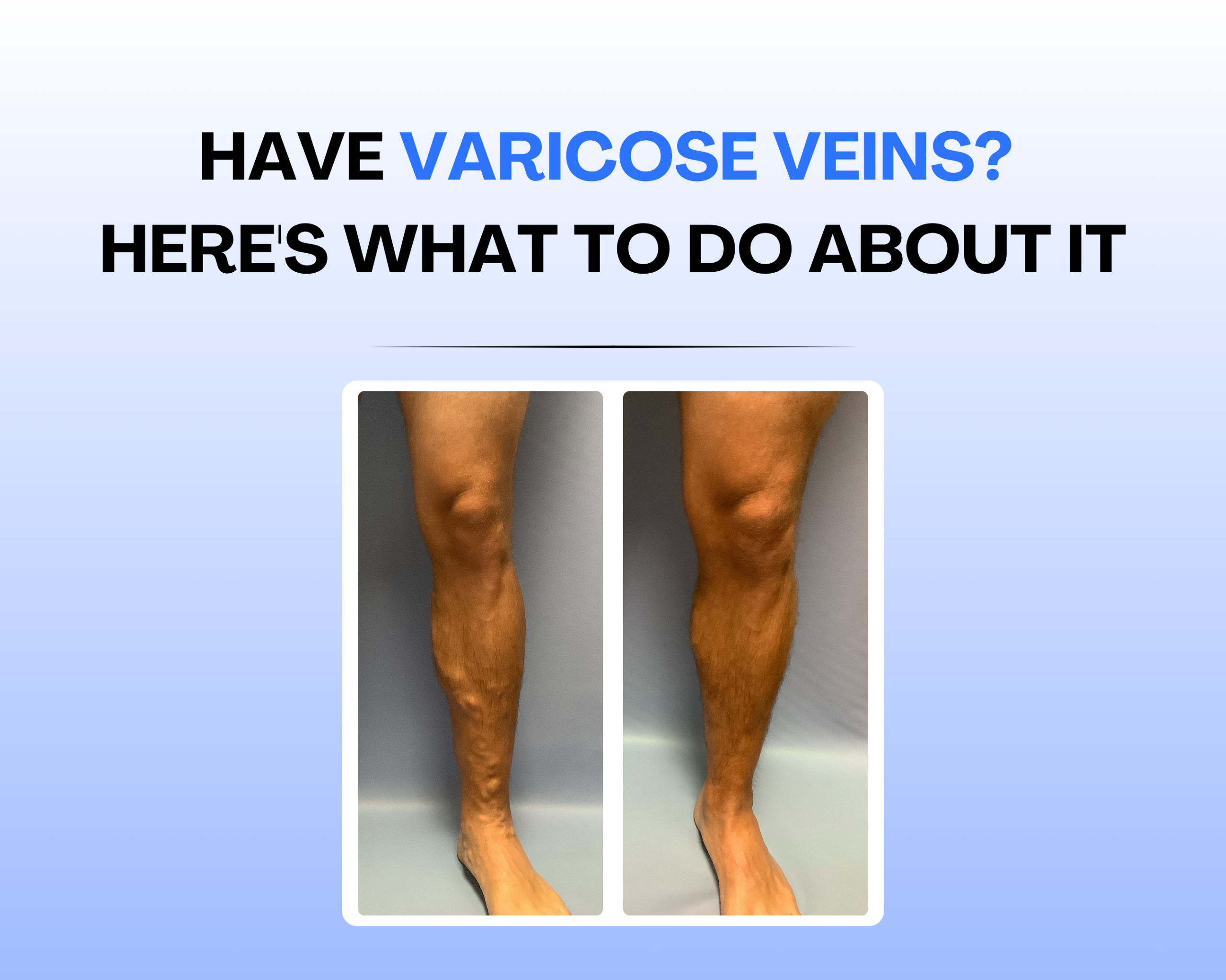Have Varicose Veins? Here’s What to Do About Them Image