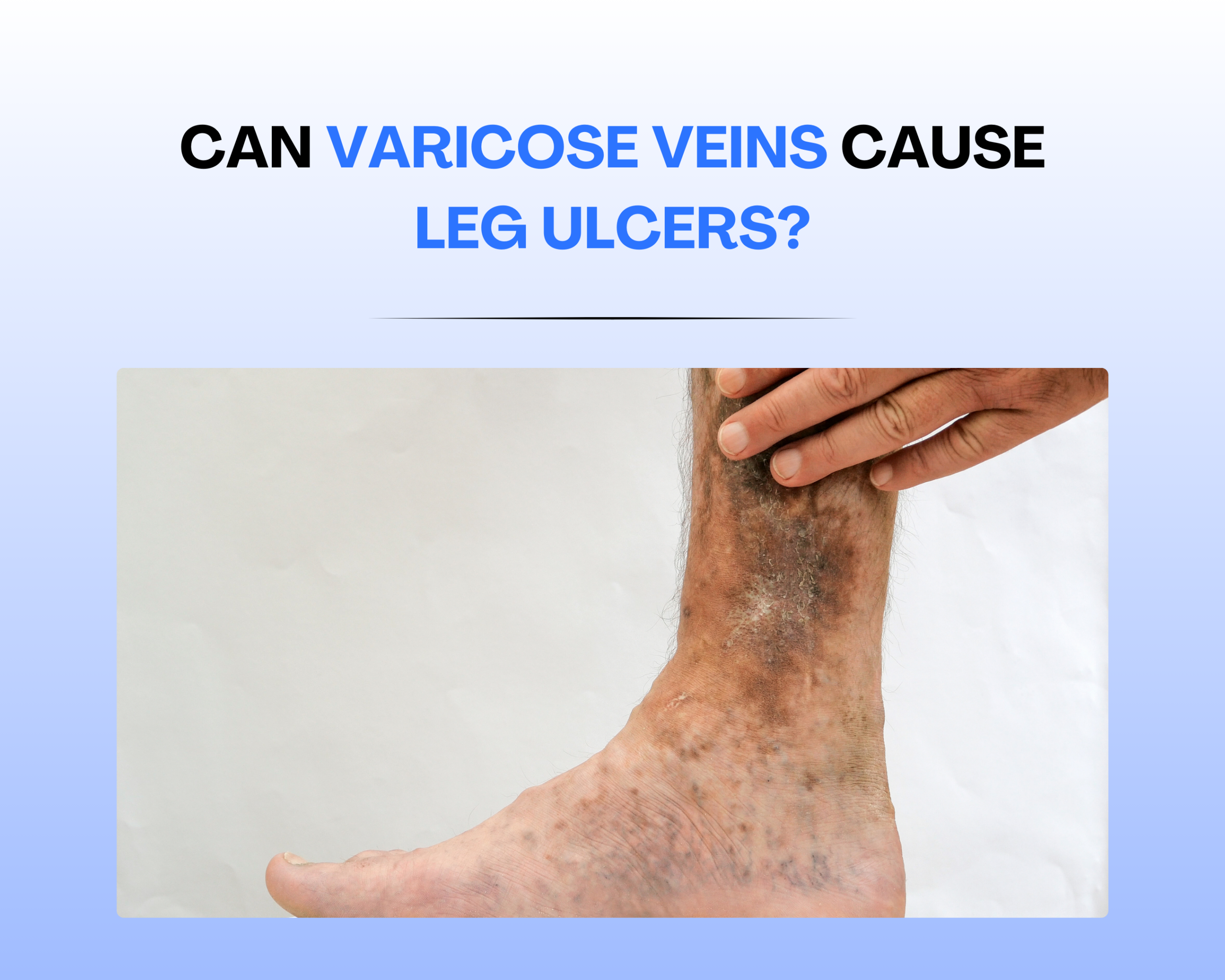 Can Varicose Veins Cause Leg Ulcers? Image