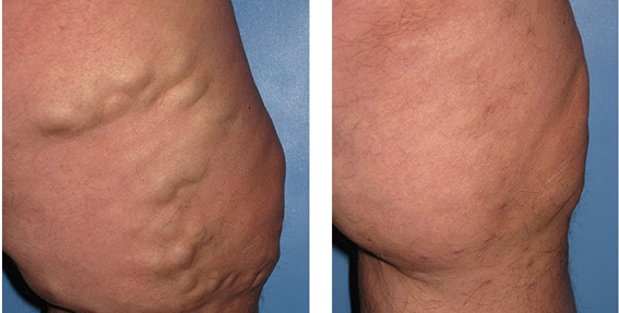Varicose Vein Case 105 Combined Image