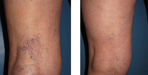 Spider Vein Case 104 Combined Image