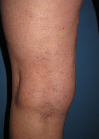 Spider Vein Case 104 After image