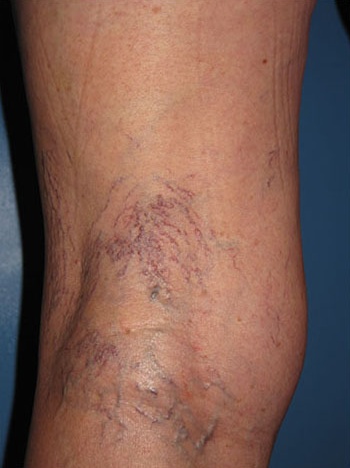 Spider Vein Case 104 Before image