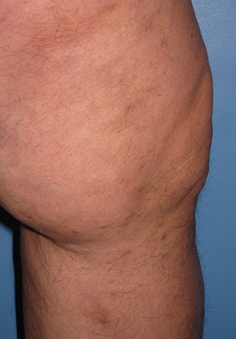 Varicose Vein Case 105 After image