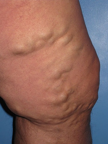 Varicose Vein Case 105 Before image