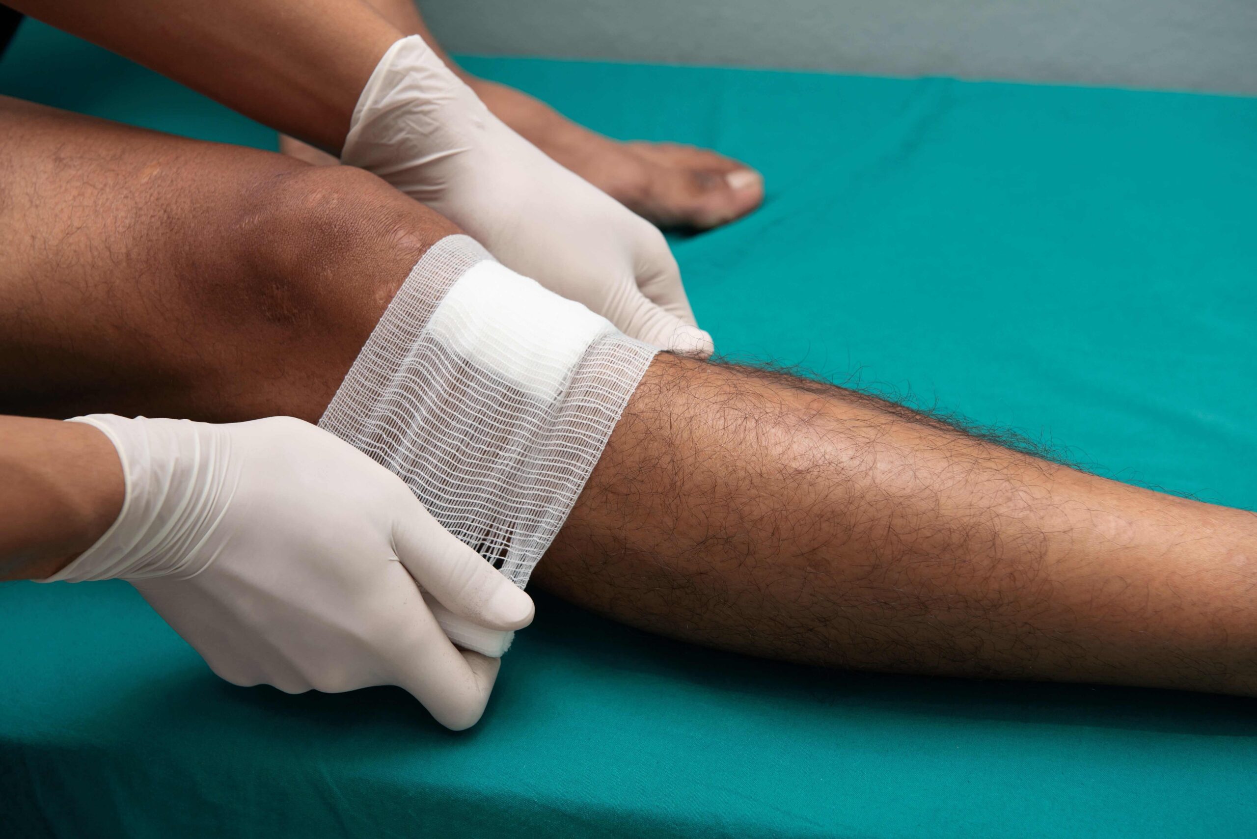 Don’t Wait, Heal: The Impact of Delayed Venous Leg Ulcer Treatment Image