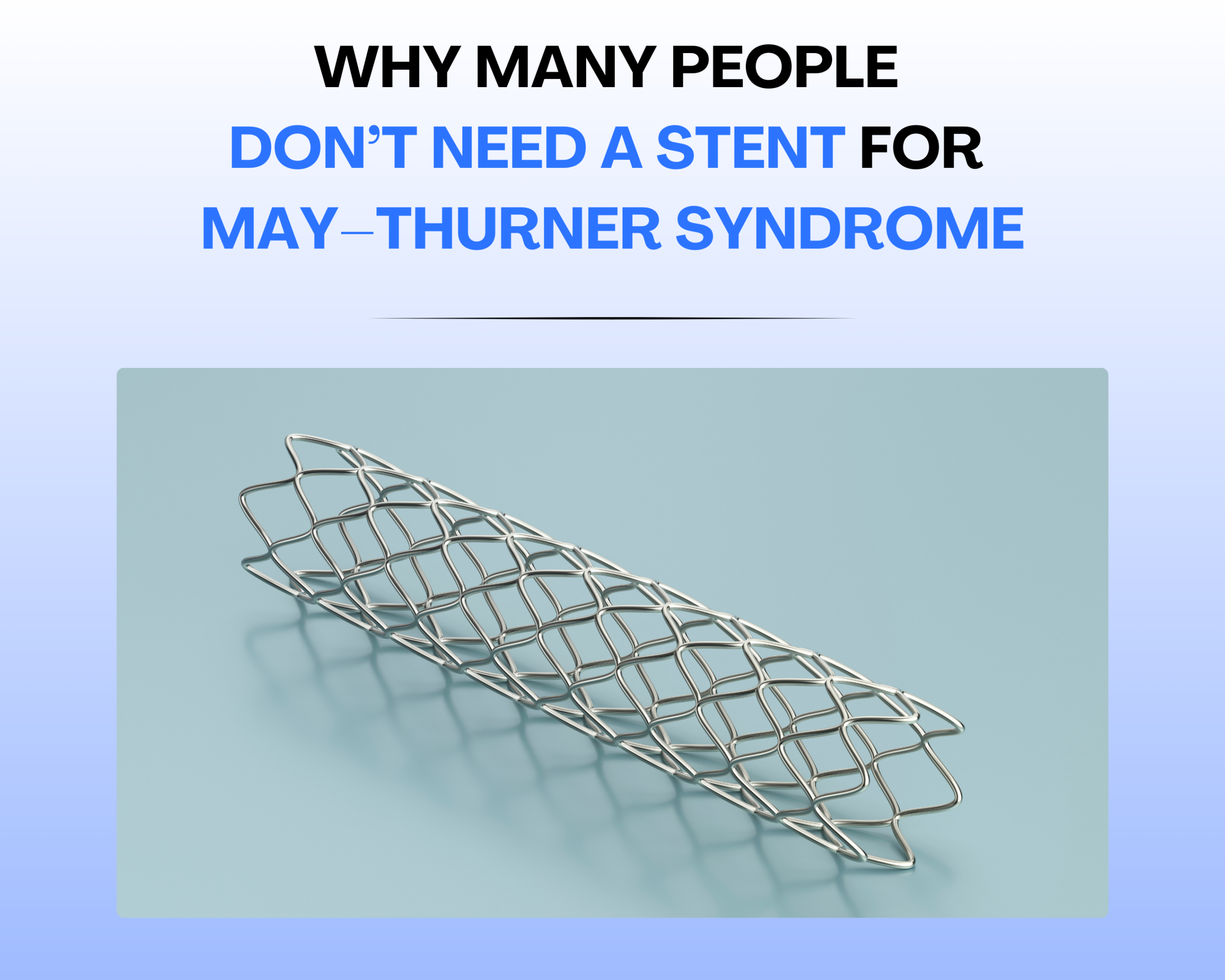 Why Many People Don’t Need a Stent for May–Thurner Syndrome Image