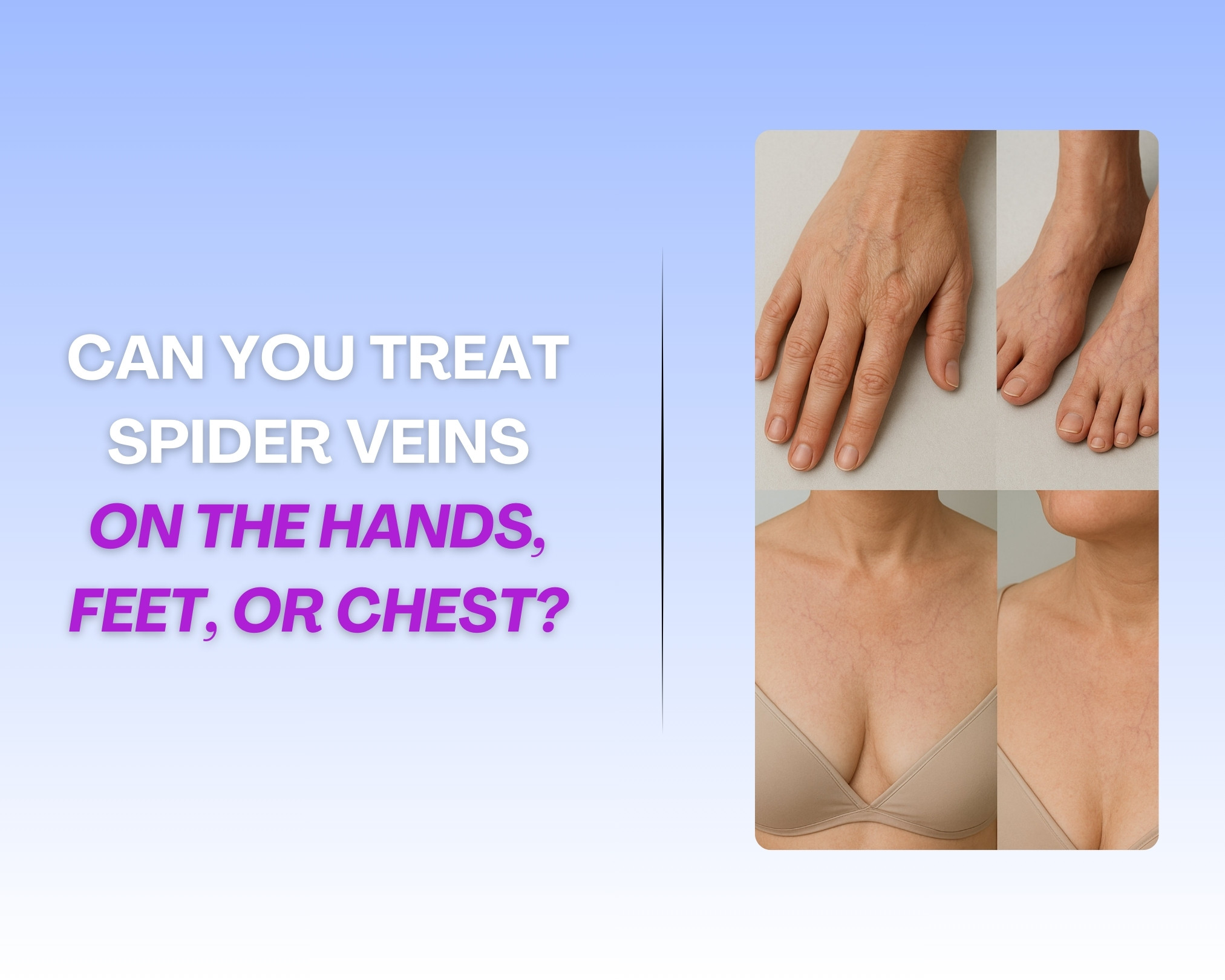 Can You Treat Spider Veins on the Hands, Feet, or Chest? Image