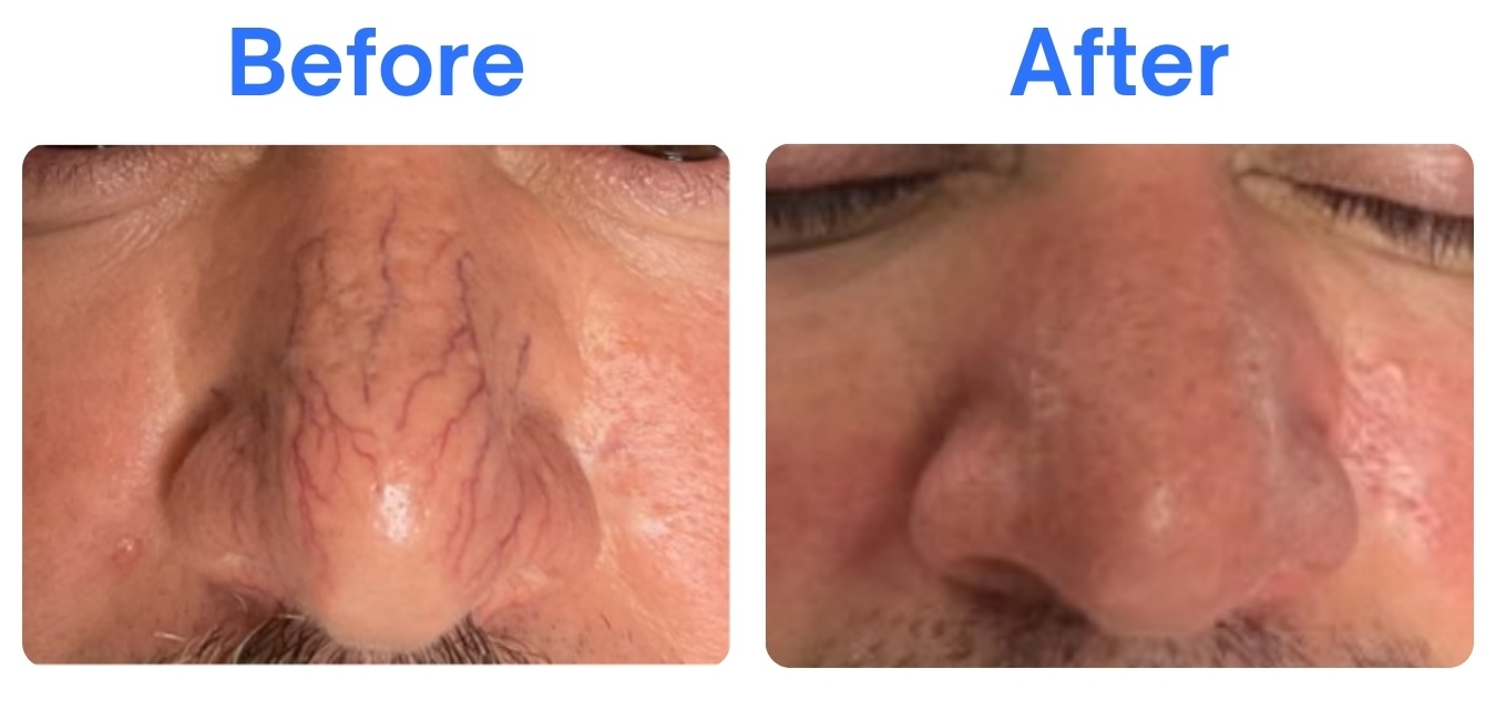 Say Goodbye to Facial Spider Veins with VeinGogh™: A Fast and Accurate Fix Image