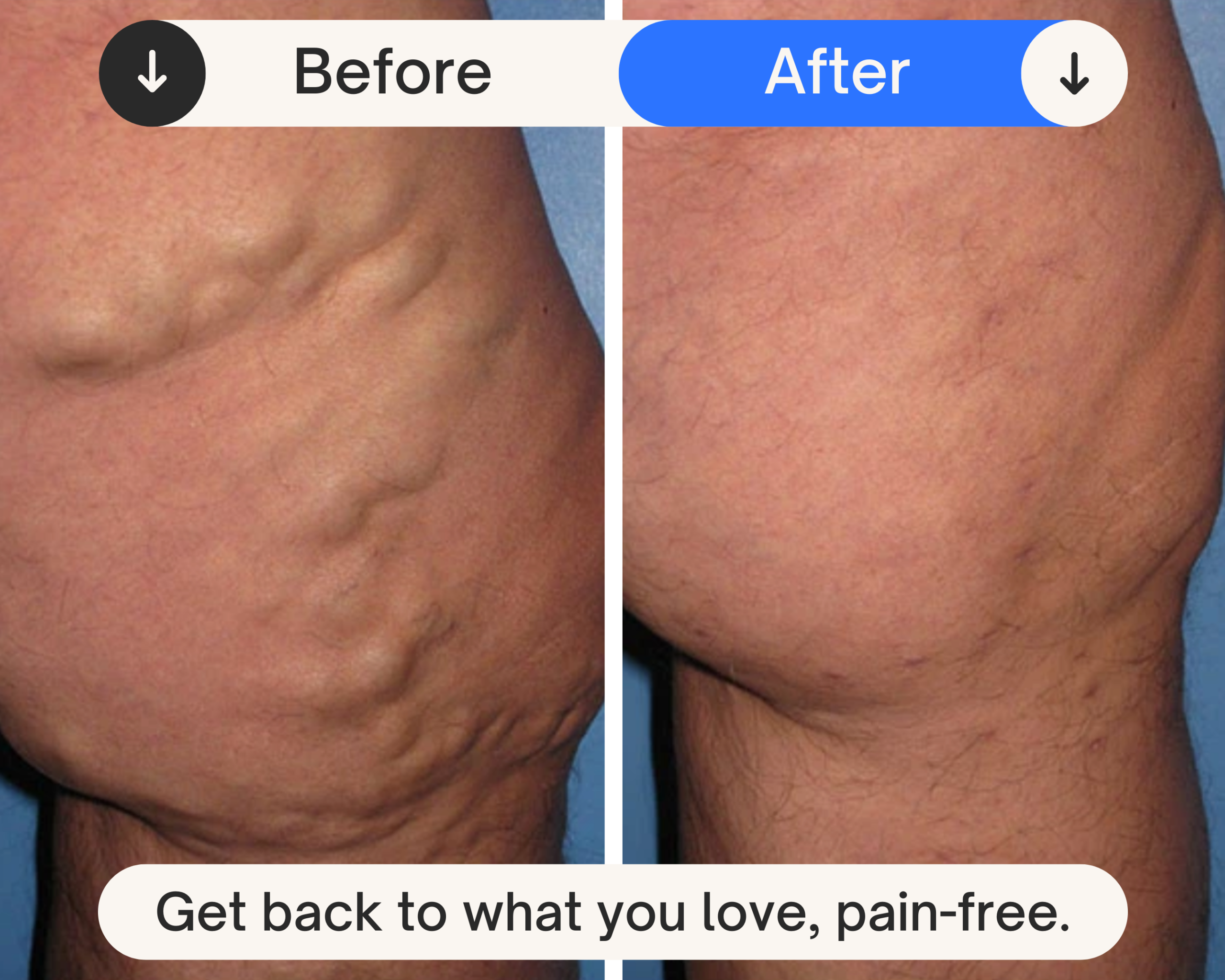 Varicose Vein Case 107 Combined Image