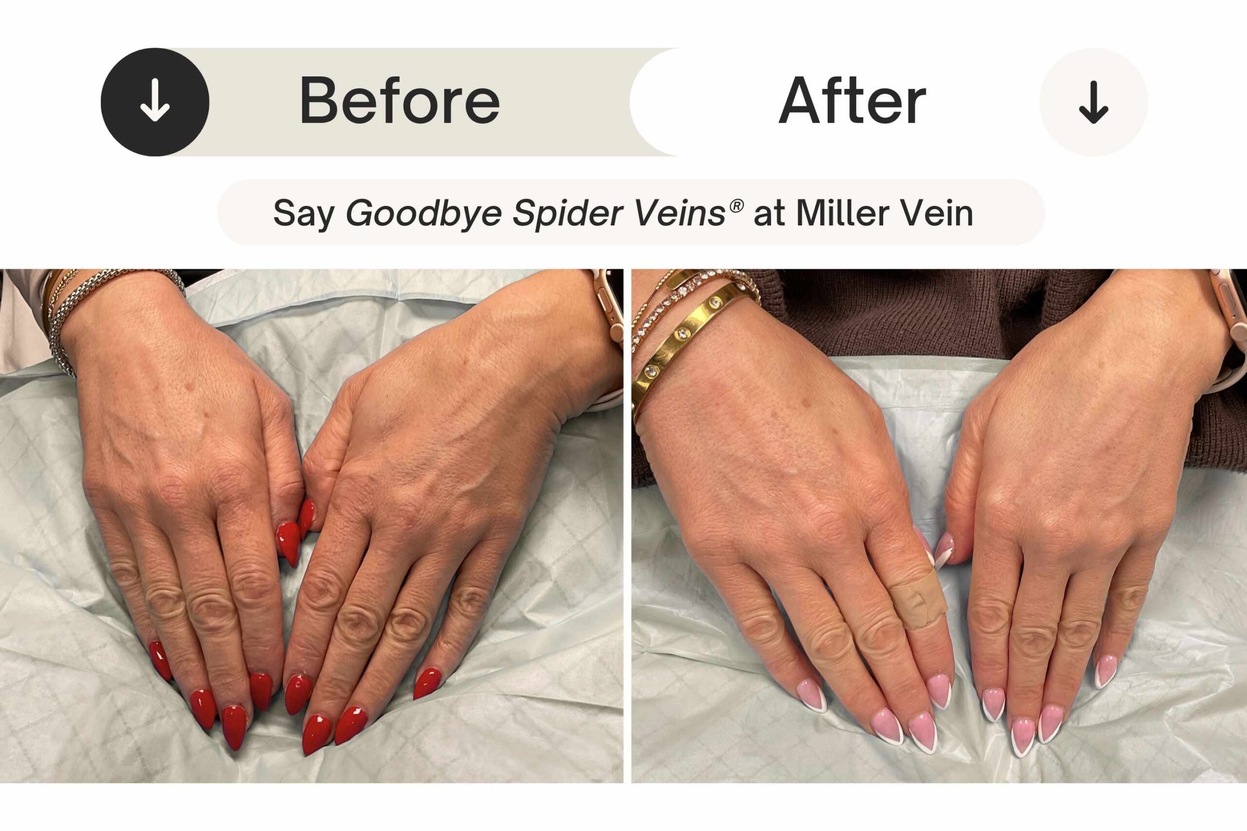 Spider Vein Case 107 Combined Image