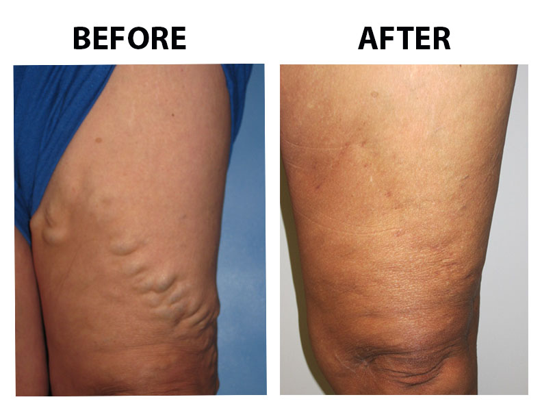 Varicose Veins Case 106 Combined Image