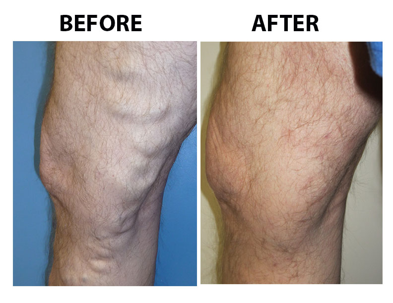 Varicose Vein Case 108 Combined Image