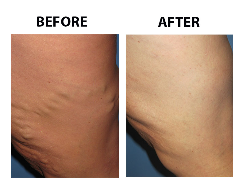Varicose Vein Case 109 Combined Image