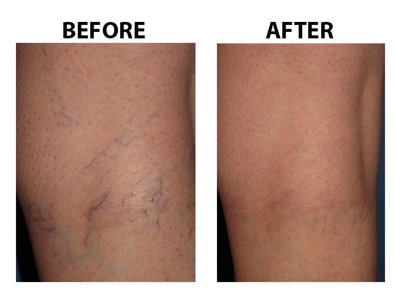 Spider Vein Case 106 Combined Image