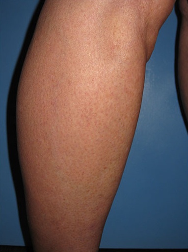 Spider Vein Case 105 After image