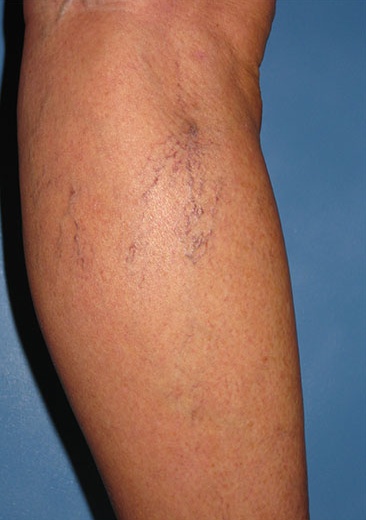 Spider Vein Case 105 Before image