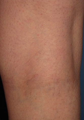 Spider Vein Case 106 After image