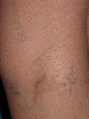 Spider Vein Case 106 Before image