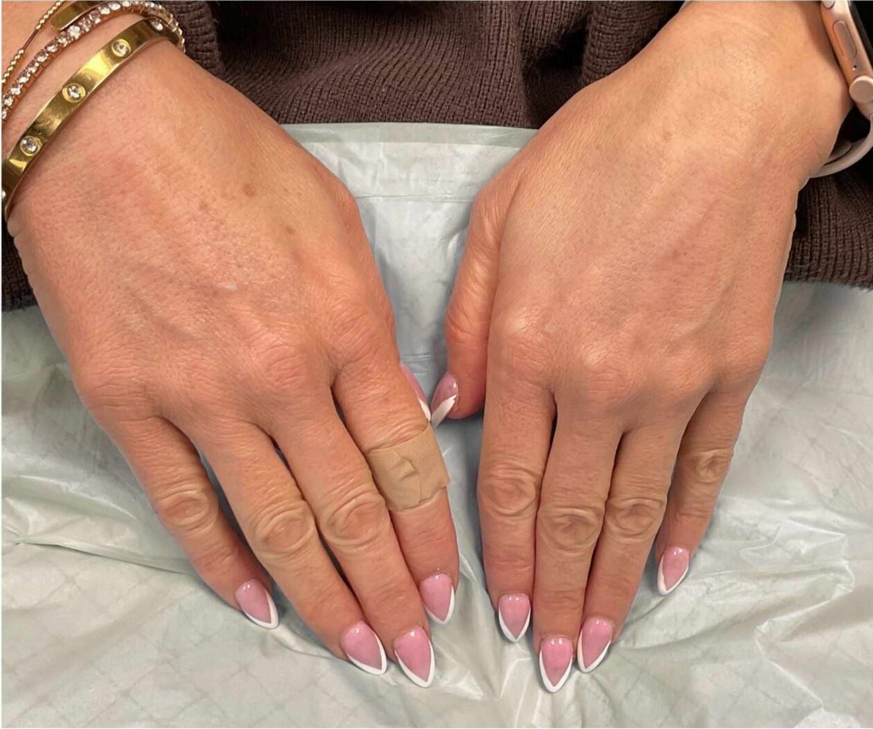 Hand Vein Case 100 After image