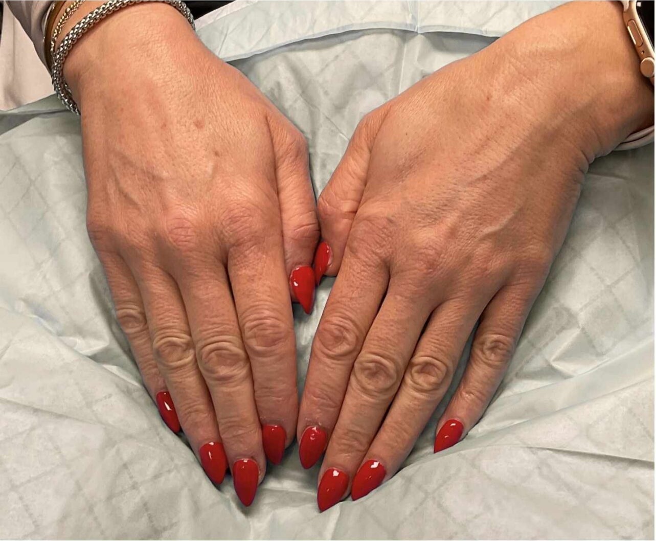 Hand Vein Case 100 Before image