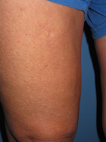 Spider Vein Case 108 After image