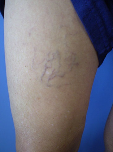 Spider Vein Case 108 Before image