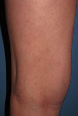Spider Vein 109 After image