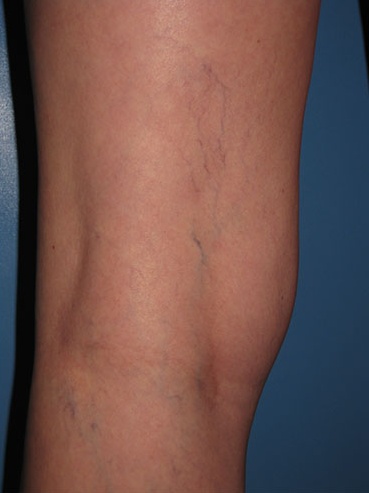Spider Vein 109 Before image