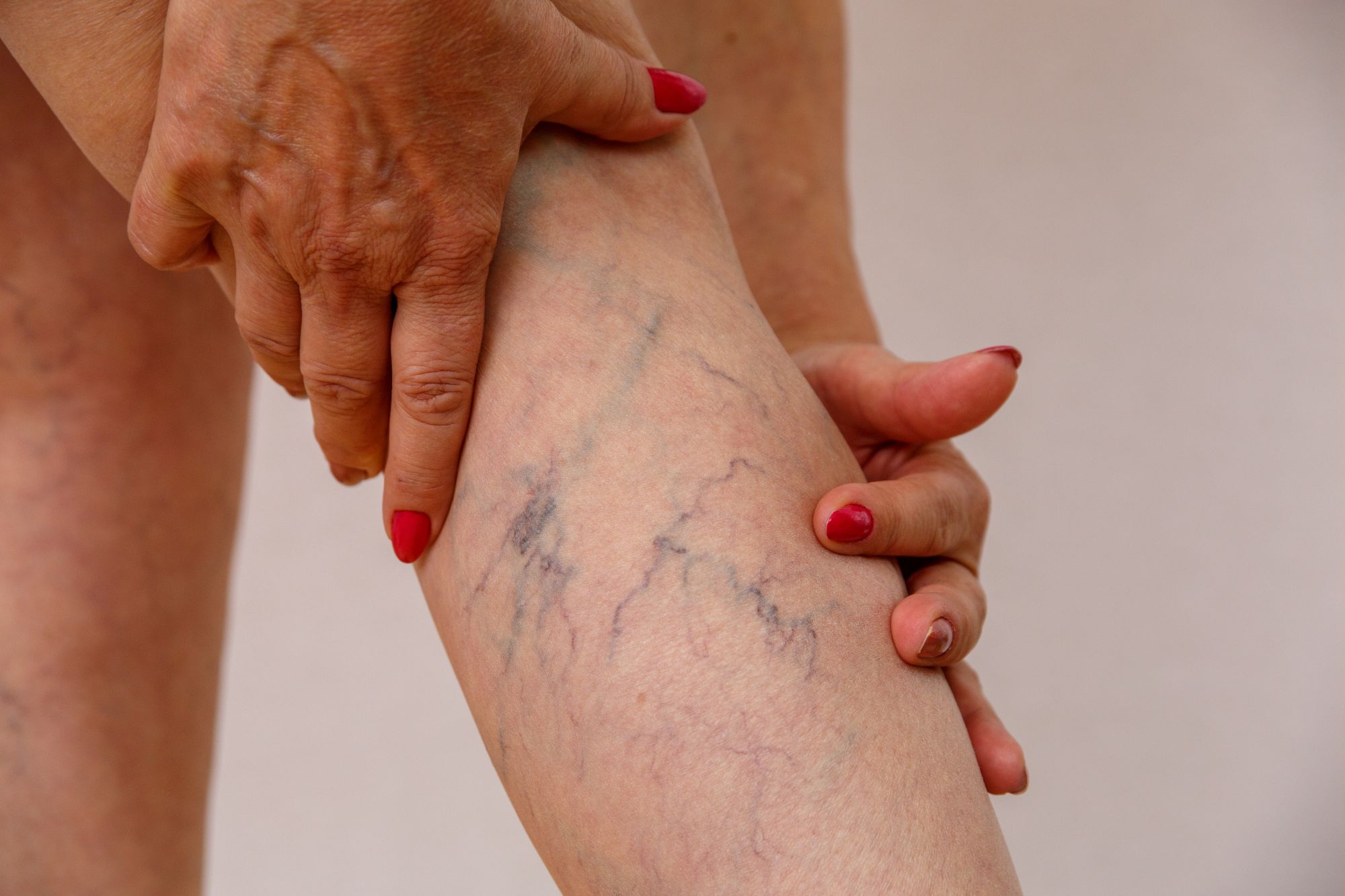 Spider Veins: Medical Definition and Clinical Overview Image