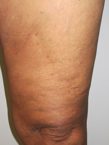 Varicose Veins Case 106 After image