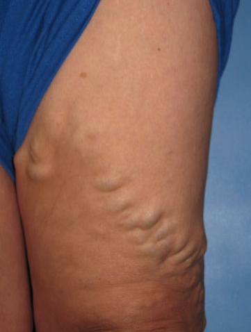 Varicose Veins Case 106 Before image