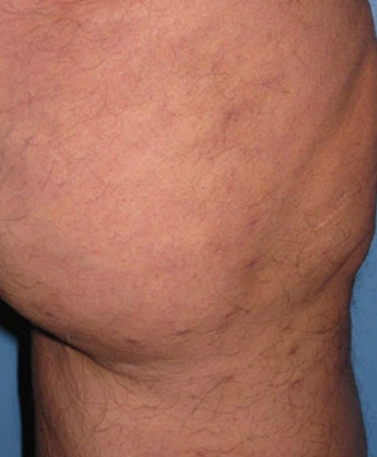 Varicose Vein Case 107 After image