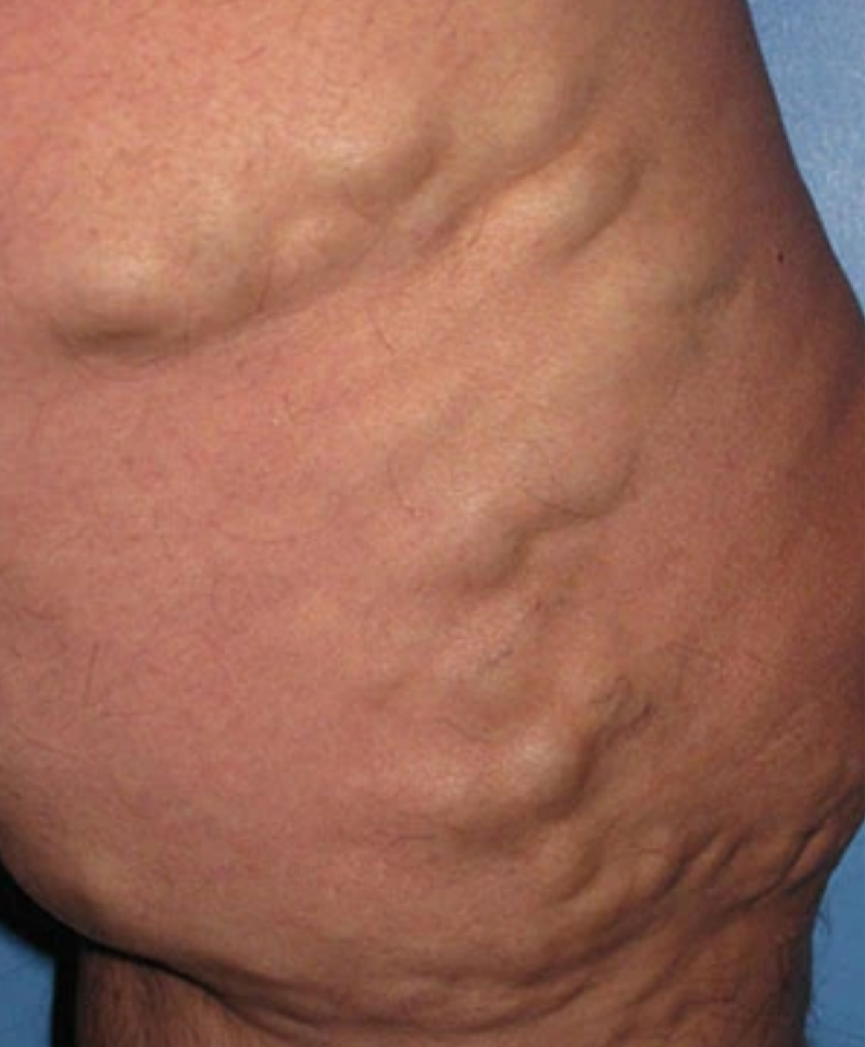 Varicose Vein Case 107 Before image