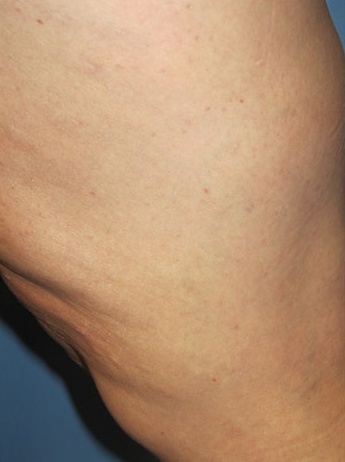 Varicose Vein Case 109 After image