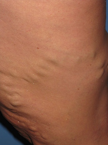 Varicose Vein Case 109 Before image