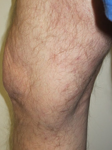 Varicose Vein Case 108 After image
