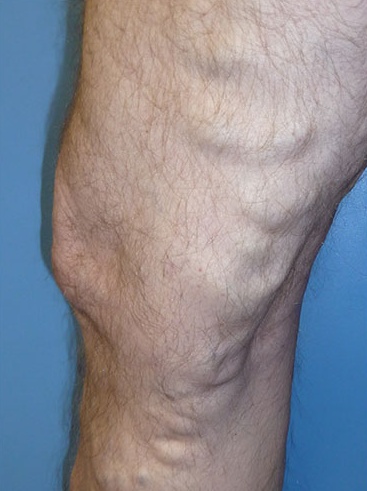 Varicose Vein Case 108 Before image