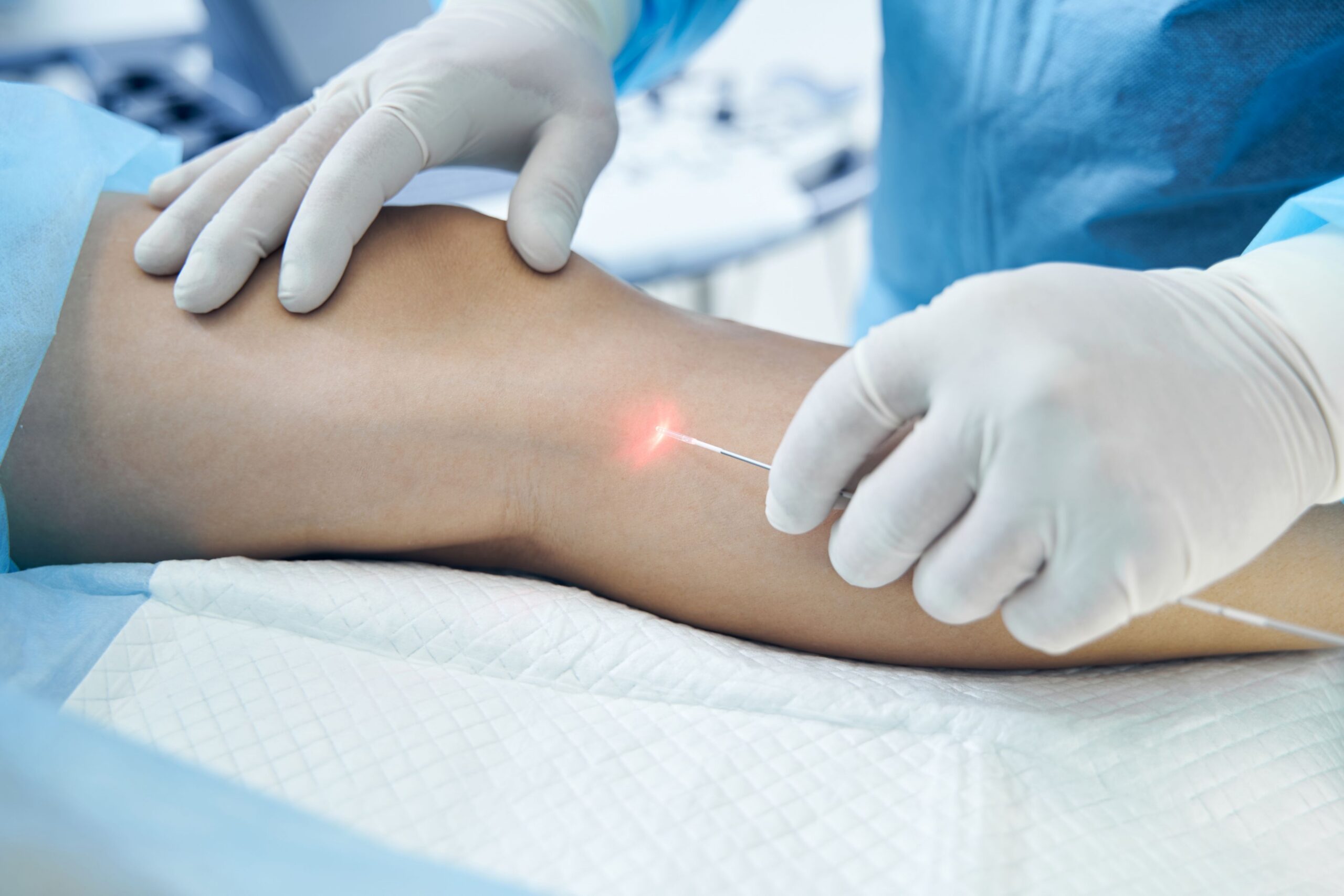 Radiofrequency Ablation vs. Endovenous Laser Ablation: Procedure Steps and What to Expect Image