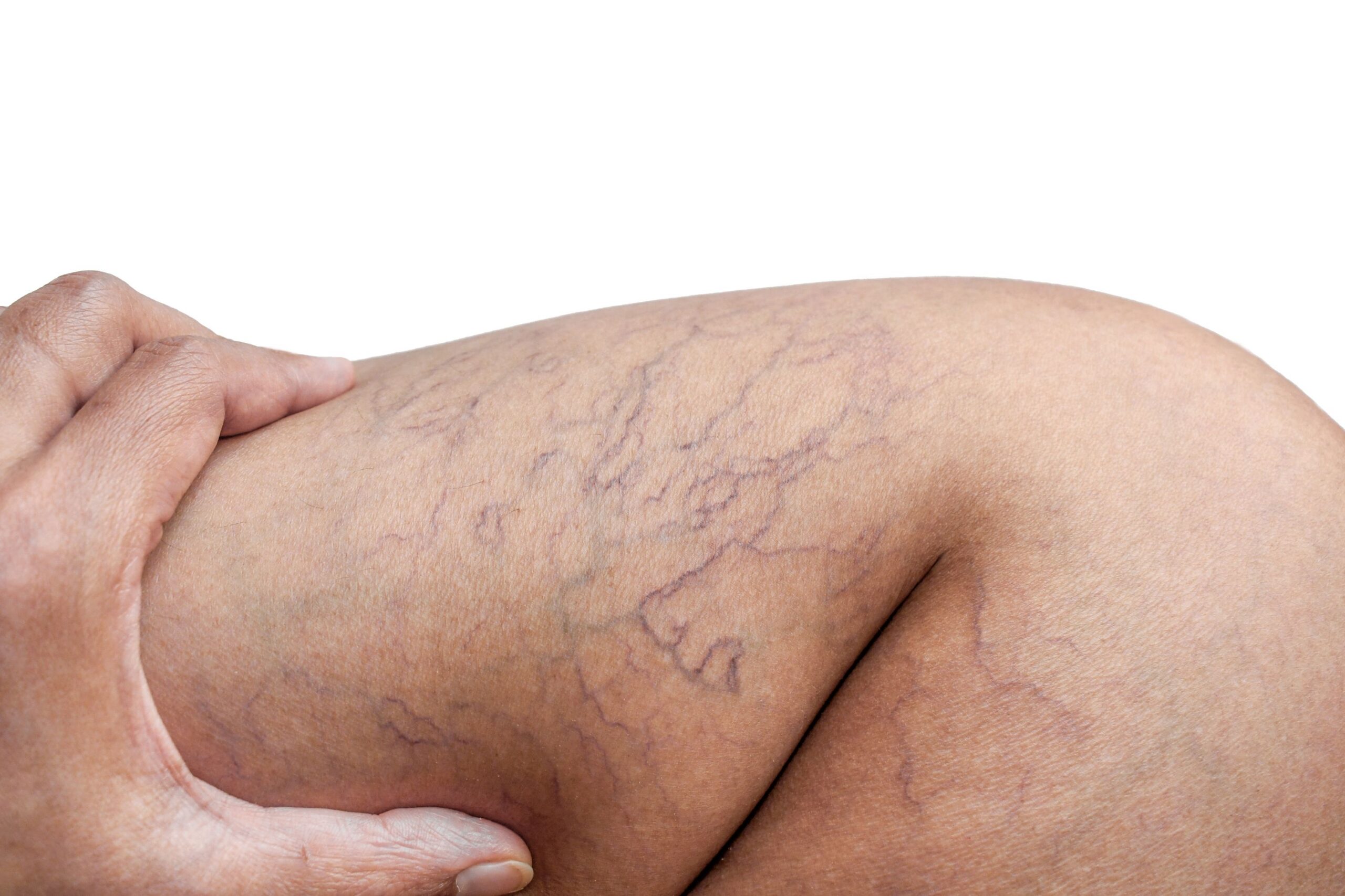 How to Get Rid of Spider Veins: Treatment Options and Removal Methods Image