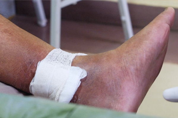 Bandaged leg wound being cared for