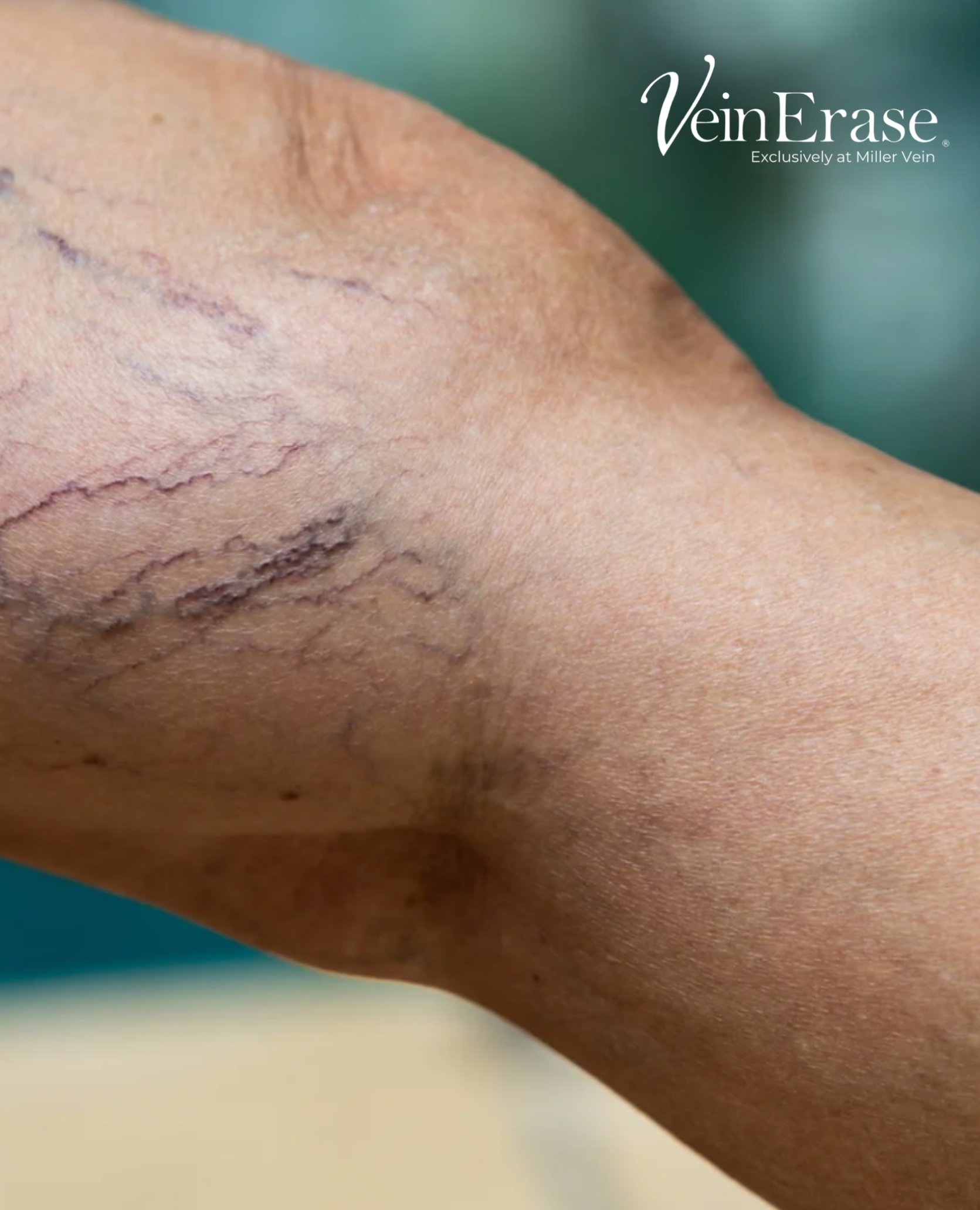 Close-up of spider veins on a leg