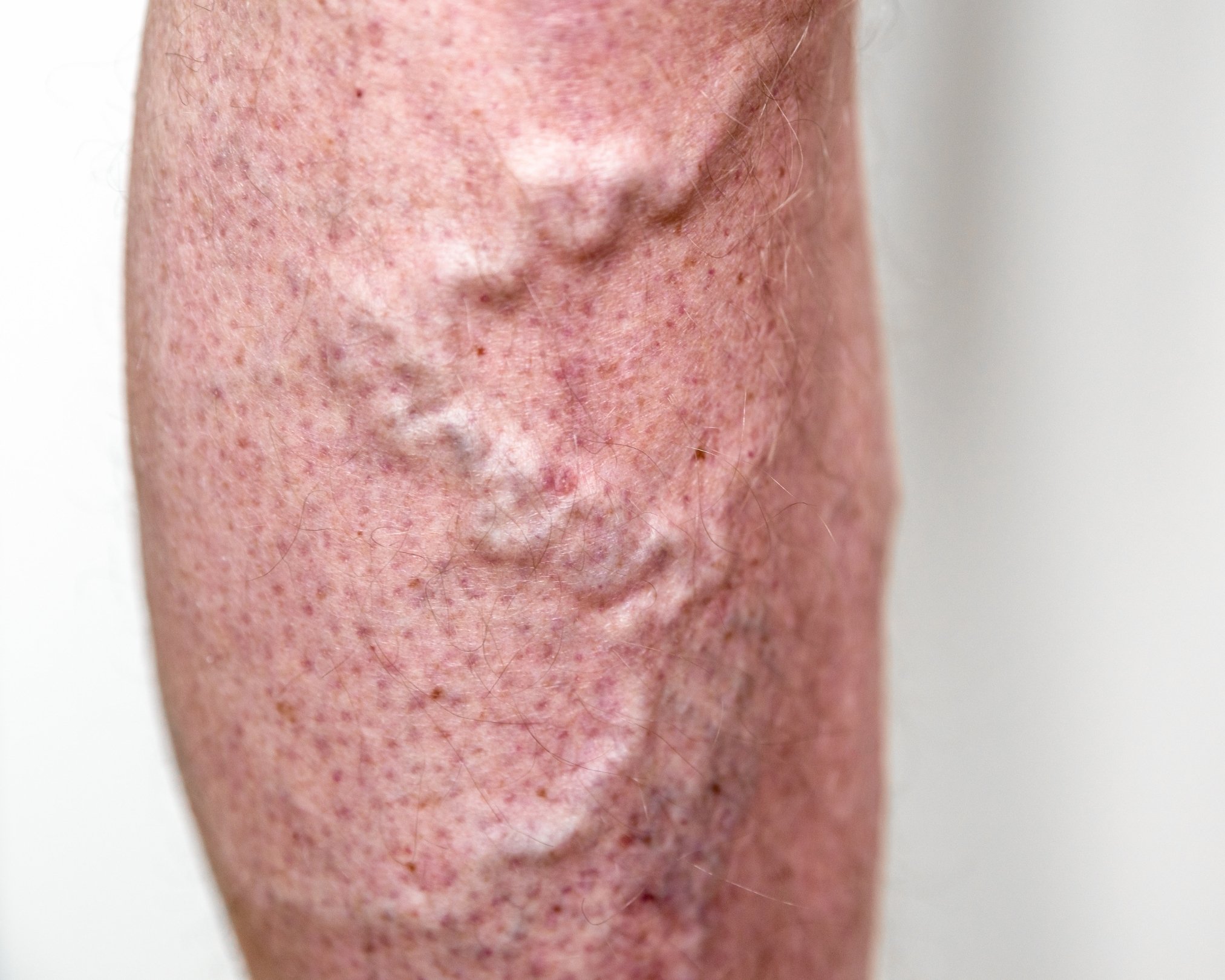 Close-up of varicose veins on a leg
