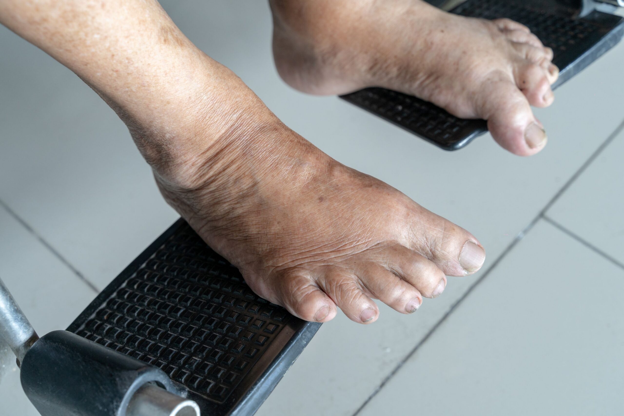 Poor Circulation in Feet: Causes and Treatment Image