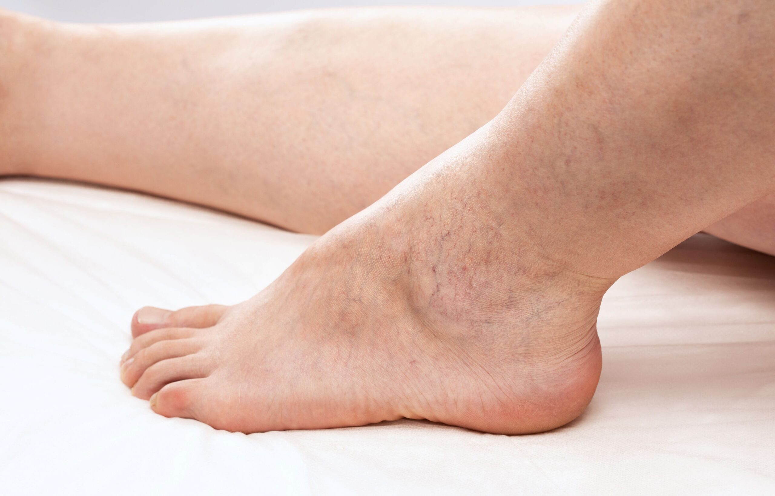 Venous Insufficiency Testing: Diagnosis and Evaluation Methods in Zeeland, Michigan Image